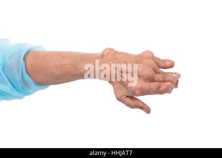 Ein Mann mit der Diagnose einer Polyarthritis (schwere Etappe). Die örtliche Klinik diagnostiziert Unfähigkeit, die Krankheit in diesem Stadium zu behandeln. Russland. Stockfoto