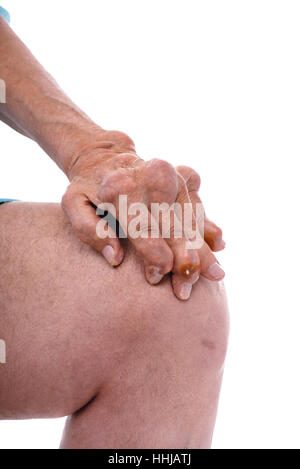 Ein Mann mit der Diagnose einer Polyarthritis (schwere Etappe). Die örtliche Klinik diagnostiziert Unfähigkeit, die Krankheit in diesem Stadium zu behandeln. Russland. Stockfoto