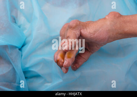 Ein Mann mit der Diagnose einer Polyarthritis (schwere Etappe). Die örtliche Klinik diagnostiziert Unfähigkeit, die Krankheit in diesem Stadium zu behandeln. Russland. Stockfoto