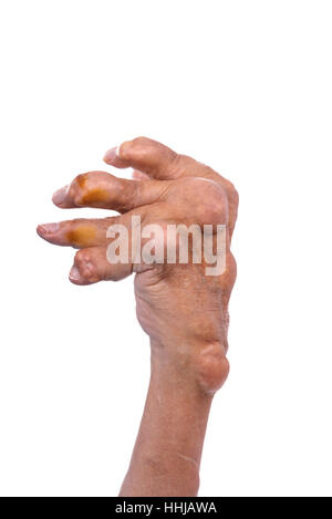 Ein Mann mit der Diagnose einer Polyarthritis (schwere Etappe). Die örtliche Klinik diagnostiziert Unfähigkeit, die Krankheit in diesem Stadium zu behandeln. Russland. Stockfoto