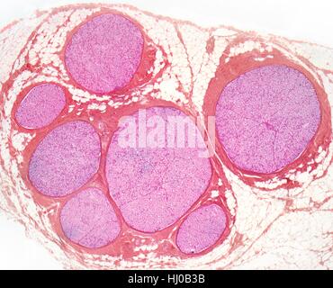 Nervenfasern. Leichte Schliffbild (LM) des einen Querschnitt durch ein Bündel (Faszikel) von Nervenfasern. Innerhalb jedes Faszikel sind viele Markhaltige Nervenfasern. Myelin (blassrosa) ist eine isolierende Fettschicht, die einzelnen Nervenfasern genannt Axone, die Erhöhung der Geschwindigkeit bei der Nervenimpulse Reisen umgibt. Die Fasern innerhalb jedes Faszikel zu unterstützen, ist das Endoneurium, die eine Form des Bindegewebes. Das Perineurium umgibt jeden Faszikel, die sind wiederum durch epineurial Bindegewebe (rot) gebunden. Vergrößerung: X80 beim Drucken 10 cm breit. Stockfoto