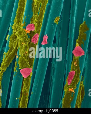 Wachs-Zahnseide mit Zahnbelag (gelb), Bakterien (Orange) Wange Zellen (rosa) auf Zahnseide Fasern (blau), farbige scanning Electron Schliffbild (SEM) verwendet. Zahnbelag besteht aus Biofilm Bakterien in Glykoprotein Matrix eingebettet. Die Matrix wird aus bakterielle Sekrete Speichel gebildet. Die Stockfoto