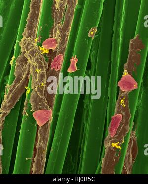 Wachs-Zahnseide mit Zahnbelag (braun), Bakterien (gelb) Wange Zellen (lila) auf Zahnseide Fasern (grün), farbige scanning Electron Schliffbild (SEM) verwendet. Zahnbelag besteht aus Biofilm Bakterien in Glykoprotein Matrix eingebettet. Die Matrix wird aus bakterielle Sekrete Speichel gebildet. Die Stockfoto