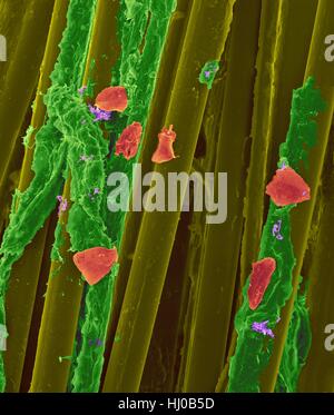 Wachs-Zahnseide mit Zahnbelag (grün), Bakterien (lila) Wange Zellen (rot) auf Zahnseide Fasern (gelb), farbige scanning Electron Schliffbild (SEM) verwendet. Zahnbelag besteht aus Biofilm Bakterien in Glykoprotein Matrix eingebettet. Die Matrix wird aus bakterielle Sekrete Speichel gebildet. Die Stockfoto
