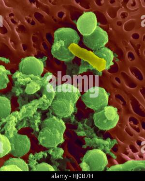 Bakterien auf einer Epithelzelle von der menschlichen Zunge fadenförmigen Papille, farbige scanning Electron Schliffbild (SEM). Kokkoiden Bakterien (wahrscheinlich Streptococcus Mutans durch die faserige Glucan-Matrix, die die Zellen umgibt) und einer Rute Bakterium sind auf die epithelialen Oberfläche gesehen. Die meisten Bakterien auf der menschlichen Zunge sind harmlos oder sogar nützlich. Einige Bakterien können jedoch Halsentzündungen und Ablagerungen bilden Plaque auf den Zähnen verursachen. Plaque führt auch zu Karies und Parodontitis. Vergrößerung: X5, 000 gedruckten kürzeste Achse bei 25 Millimetern. Stockfoto