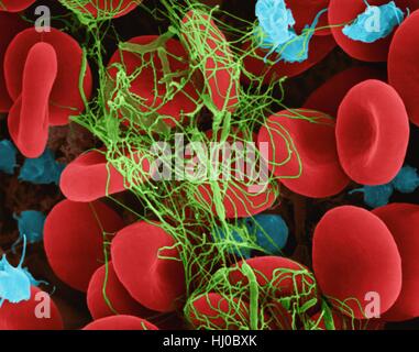 Menschlichen roten Blutkörperchen aktiviert Thrombozyten in Fibrin Blutgerinnsel gefangen, Composite farbig scanning Electron Schliffbild (SEM). Blutplättchen im Blut sind kleine ovale Scheiben nennt man nonactivated Blutplättchen oder Thrombozyten. Thrombozyten dienen als erste Verteidigungslinie des Körpers gegen übermäßigen Blutverlust. Wenn Stockfoto