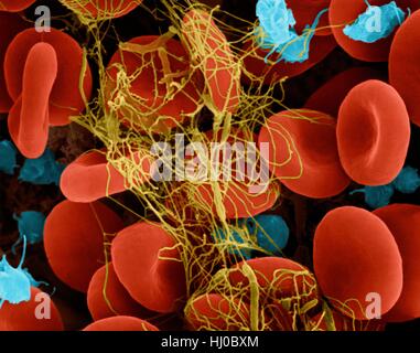 Menschlichen roten Blutkörperchen aktiviert Thrombozyten in Fibrin Blutgerinnsel gefangen, Composite farbig scanning Electron Schliffbild (SEM). Blutplättchen im Blut sind kleine ovale Scheiben nennt man nonactivated Blutplättchen oder Thrombozyten. Thrombozyten dienen als erste Verteidigungslinie des Körpers gegen übermäßigen Blutverlust. Wenn Stockfoto