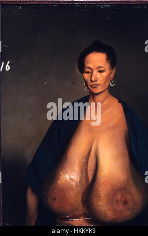 Dieses 1848 vorgestellte Kunstwerk mit dem Titel „Lam AUA Hypertrophy“ stellt eine anatomische Studie vor, die den Zustand der Hypertrophie in der menschlichen Physiologie veranschaulicht. Das Gemälde konzentriert sich auf die muskulären Veränderungen, die mit dem Zustand verbunden sind, und zeigt eine detaillierte Untersuchung des Körpers. Stockfoto