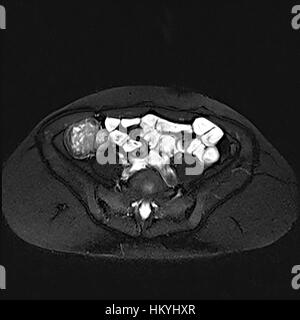 Querschnitt Enterography auch eine Magen-Darm-Studie oder Kontrast Radiographie des Magen-Darm-Trakt, genannt ist eine Serie von Röntgenaufnahmen Verwendung Stockfoto