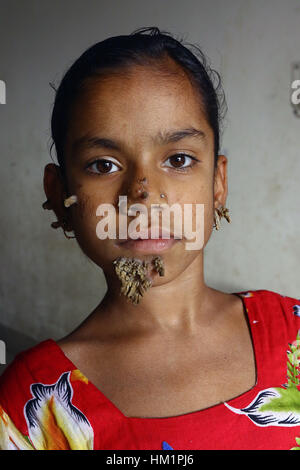 Dhaka, Bangladesch. 01 Feb, 2017. Bangladeshi Patienten Sahana Khatun, 10, posiert für ein Foto auf die Dhaka Medical College und des Krankenhauses. Ein junges Mädchen aus Bangladesch mit Rinde - wie Warzen wachsen auf Ihr Gesicht könnte die erste Frau, die jemals von so betrübt - genannt "Baum mann Syndrom, Ärzte die Untersuchung der seltenen Zustand, sagte am 31. Januar. 10-Jahr-alten Sahana Khatun hat die Klatschsüchtige knorrige Wucherungen sprießen von ihr Kinn, Ohr und Nase, aber die Ärzte bei Dhaka Medical College Hospital sind noch Tests, um festzustellen, ob Sie die ungewöhnliche Erkrankung der Haut hat. Stockfoto