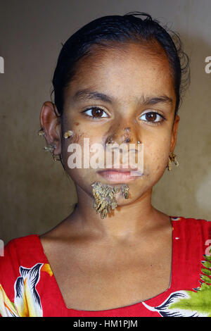 Dhaka, Bangladesch. 01 Feb, 2017. Bangladeshi Patienten Sahana Khatun, 10, posiert für ein Foto auf die Dhaka Medical College und des Krankenhauses. Ein junges Mädchen aus Bangladesch mit Rinde - wie Warzen wachsen auf Ihr Gesicht könnte die erste Frau, die jemals von so betrübt - genannt "Baum mann Syndrom, Ärzte die Untersuchung der seltenen Zustand, sagte am 31. Januar. 10-Jahr-alten Sahana Khatun hat die Klatschsüchtige knorrige Wucherungen sprießen von ihr Kinn, Ohr und Nase, aber die Ärzte bei Dhaka Medical College Hospital sind noch Tests, um festzustellen, ob Sie die ungewöhnliche Erkrankung der Haut hat. Stockfoto