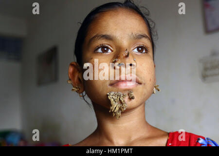 Dhaka, Bangladesch. 01 Feb, 2017. Bangladeshi Patienten Sahana Khatun, 10, posiert für ein Foto auf die Dhaka Medical College und des Krankenhauses. Ein junges Mädchen aus Bangladesch mit Rinde - wie Warzen wachsen auf Ihr Gesicht könnte die erste Frau, die jemals von so betrübt - genannt "Baum mann Syndrom, Ärzte die Untersuchung der seltenen Zustand, sagte am 31. Januar. 10-Jahr-alten Sahana Khatun hat die Klatschsüchtige knorrige Wucherungen sprießen von ihr Kinn, Ohr und Nase, aber die Ärzte bei Dhaka Medical College Hospital sind noch Tests, um festzustellen, ob Sie die ungewöhnliche Erkrankung der Haut hat. Stockfoto