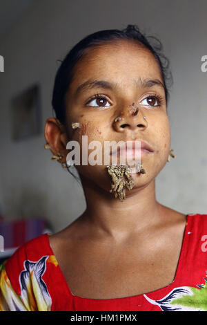 Dhaka, Bangladesch. 01 Feb, 2017. Bangladeshi Patienten Sahana Khatun, 10, posiert für ein Foto auf die Dhaka Medical College und des Krankenhauses. Ein junges Mädchen aus Bangladesch mit Rinde - wie Warzen wachsen auf Ihr Gesicht könnte die erste Frau, die jemals von so betrübt - genannt "Baum mann Syndrom, Ärzte die Untersuchung der seltenen Zustand, sagte am 31. Januar. 10-Jahr-alten Sahana Khatun hat die Klatschsüchtige knorrige Wucherungen sprießen von ihr Kinn, Ohr und Nase, aber die Ärzte bei Dhaka Medical College Hospital sind noch Tests, um festzustellen, ob Sie die ungewöhnliche Erkrankung der Haut hat. Stockfoto