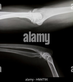 Röntgen der beiden menschlichen Beinen (normale Beine) Stockfoto