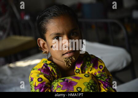 Bangladeshi Patient Sahana Khatun, 10, posiert für ein Foto an der Dhaka medizinische Hochschule und Krankenhaus. Am 1. Februar 2017 junge Mädchen aus Bangladesch mit Rinde wie Warzen im Gesicht wächst die erste Frau, die jemals von so genannten heimgesucht werden könnte "Baum-Mann-Syndrom", Ärzte, Studium der seltenen Krankheit sagte 31 Januar. Ten-Year-Old Sahana Khatun hat die verräterische knorrigen Gewächse aus ihr Kinn, Ohr und Nase sprießen, aber Ärzte am Medical College Hospital in Dhaka noch führen Tests durch, um festzustellen, ob sie die ungewöhnliche Hauterkrankung hat. Stockfoto