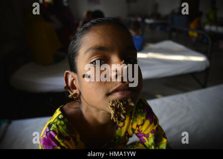 Bangladeshi Patient Sahana Khatun, 10, posiert für ein Foto an der Dhaka medizinische Hochschule und Krankenhaus. Am 1. Februar 2017 junge Mädchen aus Bangladesch mit Rinde wie Warzen im Gesicht wächst die erste Frau, die jemals von so genannten heimgesucht werden könnte "Baum-Mann-Syndrom", Ärzte, Studium der seltenen Krankheit sagte 31 Januar. Ten-Year-Old Sahana Khatun hat die verräterische knorrigen Gewächse aus ihr Kinn, Ohr und Nase sprießen, aber Ärzte am Medical College Hospital in Dhaka noch führen Tests durch, um festzustellen, ob sie die ungewöhnliche Hauterkrankung hat. Stockfoto