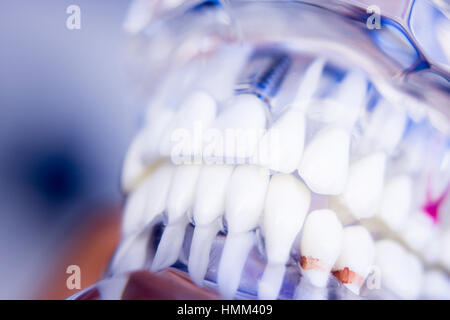 Zahnärzte Zahn Plastikmodell mit Schraubenimplantat für Lehren, lernen und Patienten in der ...