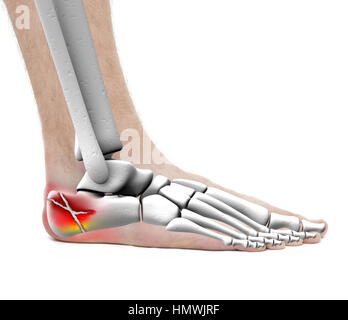Fersenbein Fraktur - Anatomie-männlich - Studio Foto isoliert auf weiss Stockfoto