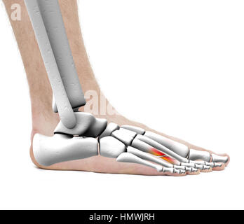 Fuß Bruch Metatarsal Knochen - Anatomie-männlich - Studio Foto isoliert auf weiss Stockfoto