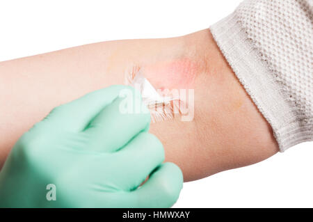 Closeup Mark der Versenkung auf weibliche Hand und Krankenschwester Bluterguss als Blut Spende Konzept Putz aufsetzen Stockfoto