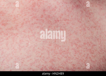 Makro der Haut mit Ausschlag von Dengue-Erkrankung Stockfoto