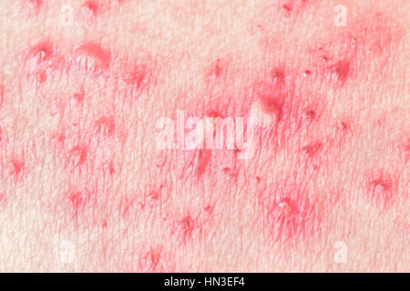 Detail der Haut mit Herpes Zoster (Gürtelrose) Stockfoto