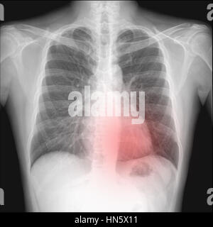 Pneumothorax in Brust Röntgen die wollen intercostral Entwässerung gesehen. Die roten Punkte zeigen. Stockfoto