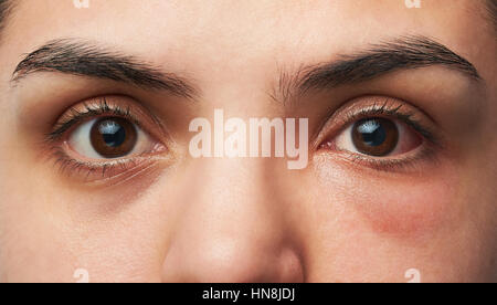 Nahaufnahme von zwei Augen der Frau mit Allergie Reaktion auf einem roten Auge Stockfoto