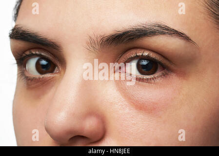 Nahaufnahme von junge Frau mit roten Augen, isoliert auf weiss Stockfoto