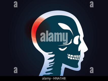 Haben Sie im Kopf des Menschen ein rotes Signal. Diese Illustration über einen Gehirntumor. Stock Vektor