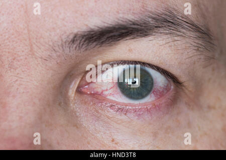 Nahaufnahme von weiten, offenen rote und gereizte Augen Stockfoto