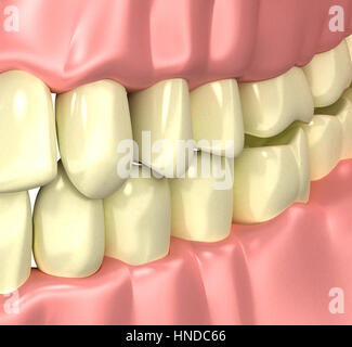 Rauchern gelbe schlechte Zähne Konzept - 3d illustration Stockfoto