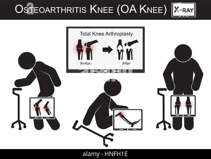 Alte Mann Schmerzen im Knie, Monitor zeigen Bild der insgesamt Knie Arthroplasty (vor und nach der chirurgischen Behandlung) Arthrose Knie Vektor (flache des Stock Vektor