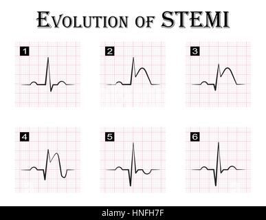 ECG der Evolution (Schritt für Schritt) von akutem Koronarsyndrom STEMI (ST-Elevation-Myokardinfarkt), Angina pectoris Stock Vektor