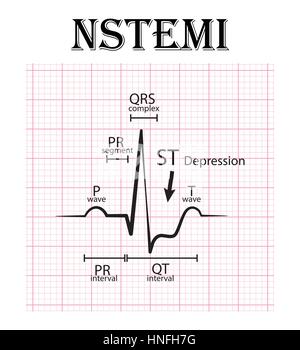 ECG nicht ST Höhe Myokardinfarkt (NSTEMI) und EKG (P-Welle, QT-Intervall, PR-Segment, PR-Intervall, QRS-Komplex ST drücken, Stock Vektor