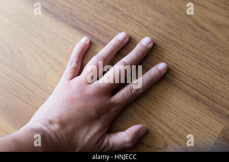 geschwollene Hand vom Insekt Wespenstich Stockfoto