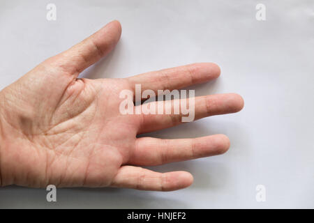 geschwollene Hand vom Insekt Wespenstich Stockfoto