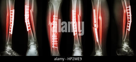 Kollektion Bild Bein Fraktur und chirurgische Behandlung durch interne Fixation mit Platte und Schrauben. Tibia und Fibula Knochen zu brechen. Stockfoto