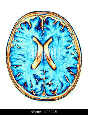 Normale Gehirn. Farbige Magnetresonanz-Bildgebung (MRI) Scan von einem axialen Schnitt durch ein gesundes Gehirn, der Bilder zeigt den Kortex und seitlichen Ventrikel (X-Form in der Mitte). Stockfoto