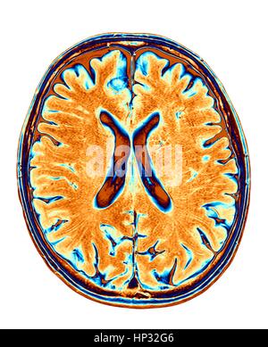 Normale Gehirn. Farbige Magnetresonanz-Bildgebung (MRI) Scan von einem axialen Schnitt durch ein gesundes Gehirn, der Bilder zeigt den Kortex und seitlichen Ventrikel (X-Form in der Mitte). Stockfoto