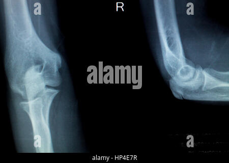 Ellenbogen Sie gemeinsamer Tennisarm Verletzungen Röntgenergebnis Test Scan vor Traumatologie und Orthopädie Chirurgie. Stockfoto