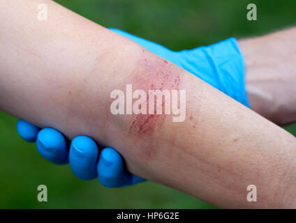 Des Arztes Hand Heilung eine verbrannte Hautstelle Stockfoto