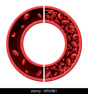 Blutarmut und Anämie medizinischen Diagramm-Konzept als normal und abnormal Blutbild und menschlichen Kreislauf in eine Arterie oder Vene. Stockfoto