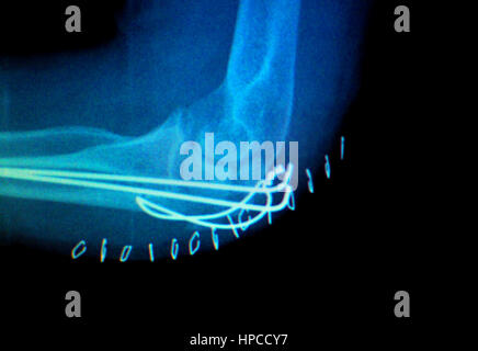 Ellenbogen gemeinsame Titanium Metall moderne Implantat Röntgen-Test-Scan-Ergebnis nach der Operation für Traumatologie und Orthopädie. Stockfoto