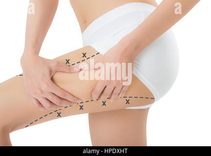 Frau packte Haut auf ihren Oberschenkel mit der schwarzen Farbe Kreuze markieren, verlieren Gewicht und Fettabsaugung Cellulite Entfernung Konzept, Isolated on white backgr Stockfoto