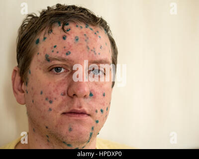 Varizella-Zoster-Virus oder Windpocken Blase Ausschlag auf Kind, Baby oder Erwachsener. Nahaufnahme Bild eine frische Blister. Mann mit Windpocken. Stockfoto