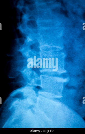 Orthopädie, untere Wirbelsäule, Becken und Hüften Röntgen scan-Testergebnisse für Alter Patienten mit Rückenschmerzen und Arthritis. Stockfoto