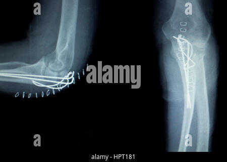 Ellenbogen gemeinsame Titanium Metall moderne Implantat Röntgen-Test-Scan-Ergebnis nach der Operation für Traumatologie und Orthopädie. Stockfoto