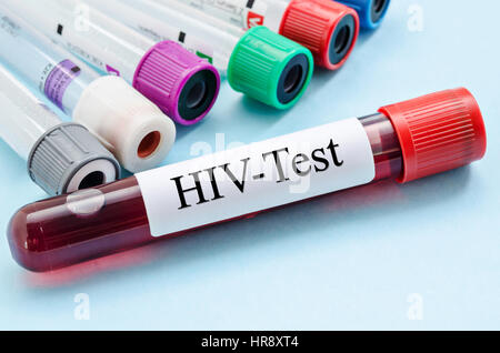 Blut Sammlung Probenröhrchen mit HIV-Test-Label im Labor. Stockfoto