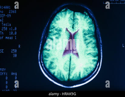 MRI-Bild des menschlichen Gehirns Stockfoto